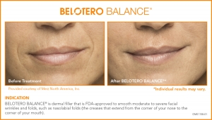 BELOTERO Injectable Filler Before and After BELOTERO Injectable Filler Before and After