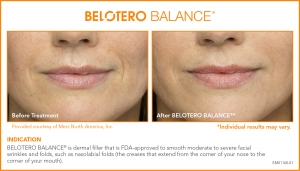 BELOTERO Injectable Filler Before and After BELOTERO Injectable Filler Before and After