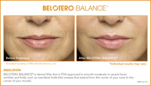 BELOTERO Injectable Filler Before and After BELOTERO Injectable Filler Before and After