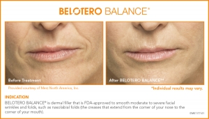 BELOTERO Injectable Filler Before and After BELOTERO Injectable Filler Before and After