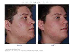 Obagi CLENZIderm Anti Acne Treatment Fort Myers Obagi CLENZIderm Anti Acne Treatment Fort Myers Before and After