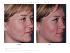 Obagi CLENZIderm Anti Acne Treatment Obagi CLENZIderm Anti Acne Treatment Fort Myers Before and After