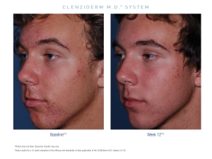 Obagi CLENZIderm Anti Acne Treatment Obagi CLENZIderm Anti Acne Treatment Fort Myers Before and After