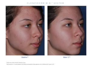 Obagi CLENZIderm Anti Acne Treatment Obagi CLENZIderm Anti Acne Treatment