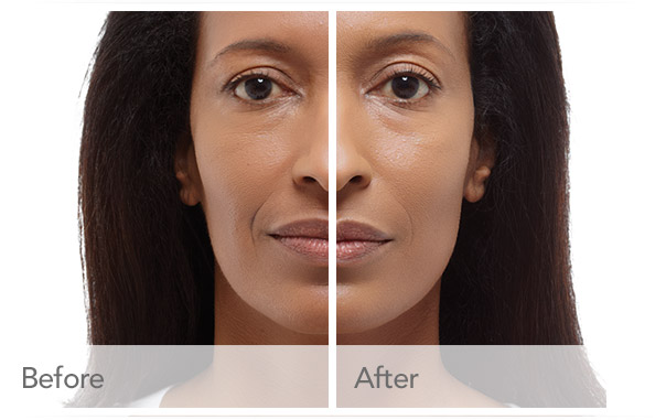 Radiesse Wrinkle Filler Before – After Radiesse Wrinkle Filler Before - After