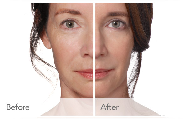 Radiesse Wrinkle Filler Before – After Radiesse Wrinkle Filler Before - After