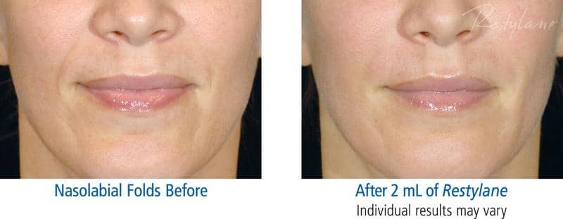 Restylane Wrinkle Filler Before and After Restylane Wrinkle Filler Before and After