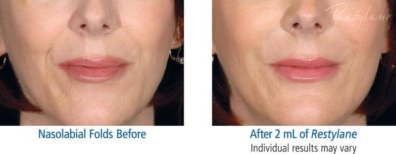 Restylane Wrinkle Filler Before and After Restylane Wrinkle Filler Before and After