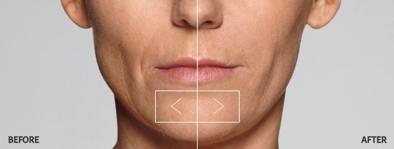 Restylane Line Filler Before and After Restylane Line Filler Before and After