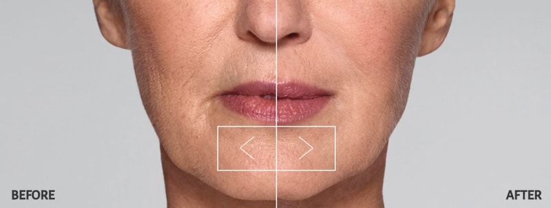 Restylane Line Filler Before and After Restylane Line Filler Before and After