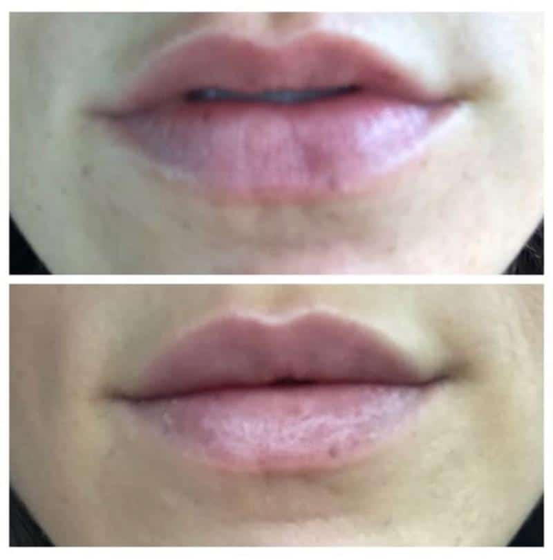 Restylane Line Filler Before and After Restylane Line Filler Before and After
