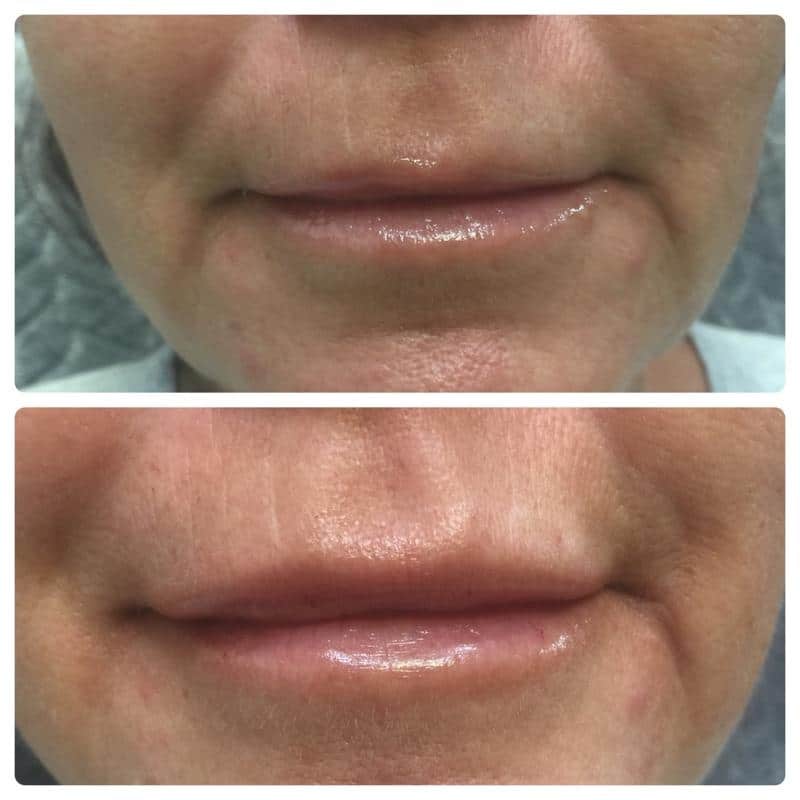 Restylane Line Filler Before and After Restylane Line Filler Before and After