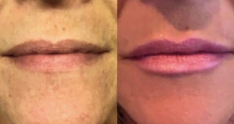 Restylane Line Filler Before and After Restylane Line Filler Before and After