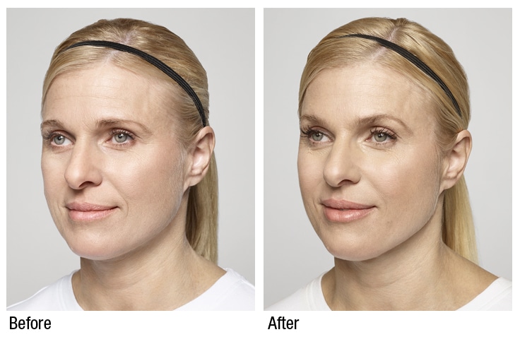 Restylane Cheek Restoration Before and After Restylane Cheek Restoration Before and After