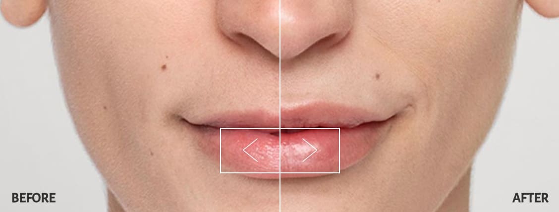 Restylane Silk Lip Filler Before and After Restylane Silk Lip Filler Before and After
