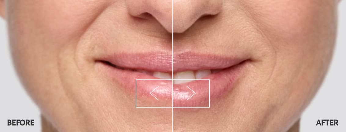Restylane Silk Lip Filler Before and After Restylane Silk Lip Filler Before and After
