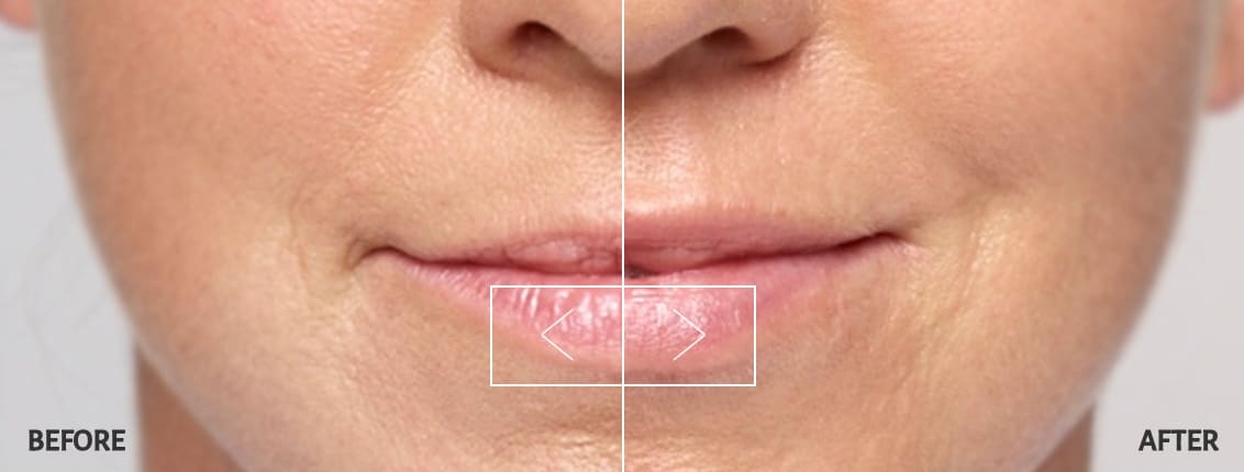 Restylane Silk Lip Filler Before and After Restylane Silk Lip Filler Before and After