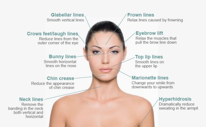 Dysport Anti Wrinkle-Treatment Dysport Anti Wrinkle-Treatment