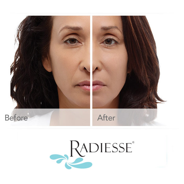 Radiesse Wrinkle Filler Radiesse Wrinkle Filler
