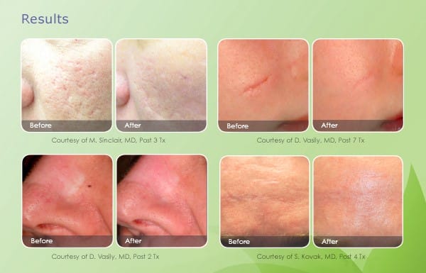 1540-Scar-BeforeAfter 1540-Scar-BeforeAfter