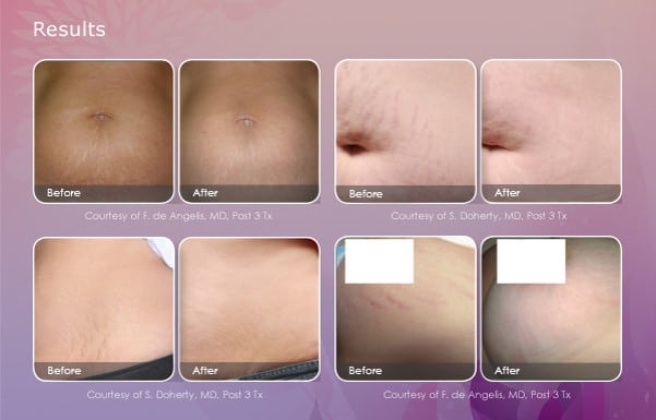 1540-Stretch-Mark-BeforeAfter
