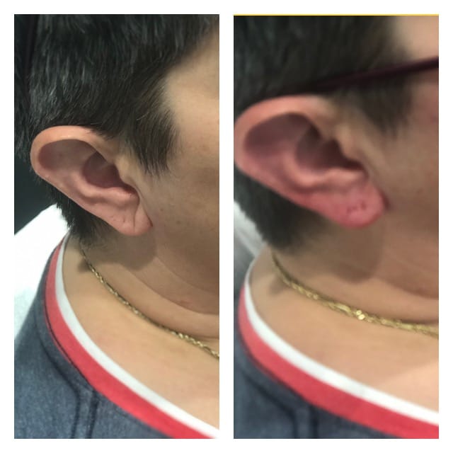 Ear Lobe Rejuvenation in Naples Ear Lobe Rejuvenation in Naples
