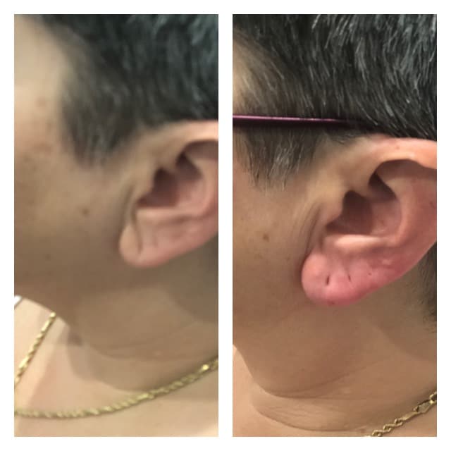 Ear Lobe Rejuvenation in Naples and Fort Myers