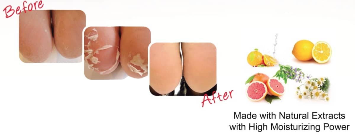 Babyfoot Foot Skin Care Babyfoot Foot Skin Care Fort Myers Before and After
