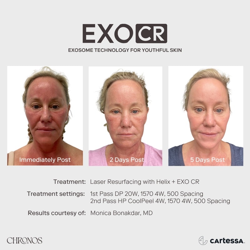 chronos exsome rejuvenation therapy before and after results in naples and fort myers, fl
