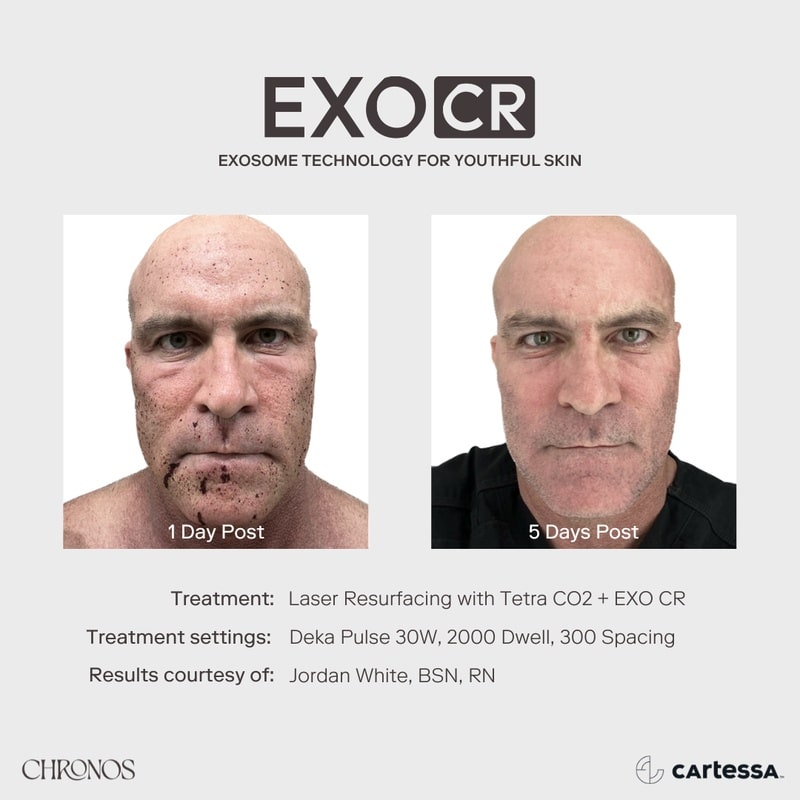 chronos exosome rejuvenation therapy before and after results in cape coral and bonita springs, fl