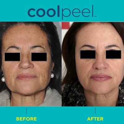 coolpeel-before-after coolpeel before and after results in fort myers and naples, fl