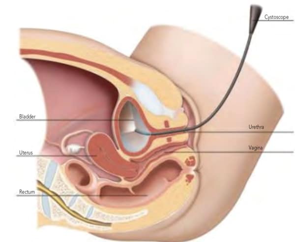 Cystocopy Procedure Naples