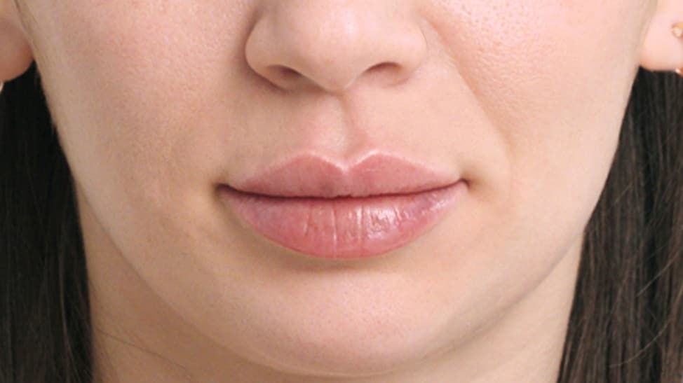 dermal filler for lips in fort myers and naples