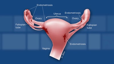 Endometriosis Treatment Fort Myers Naples Endometriosis Treatment Fort Myers Naples