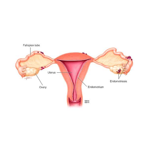 Endometriosis Treatment Fort Myers Naples