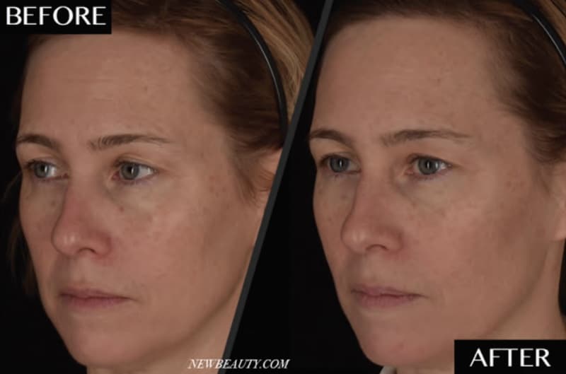 ezGel PRF before and after results