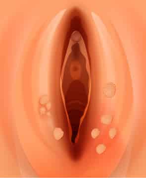 Genital-Lesions-therapy-Fort-Myers Genital Lesions Removal Therapy Fort Myers