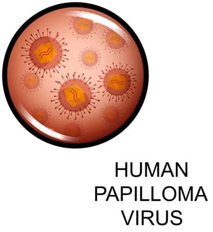 Genital Lesions Removal HPV Genital Lesions Removal Therapy Fort Myers HPV