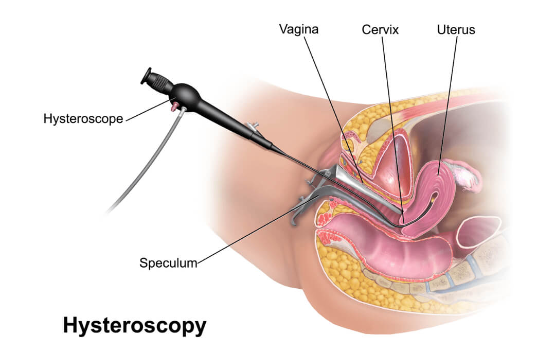 Hysteroscopy in Fort Myers and Naples Hysteroscopy in Fort Myers and Naples