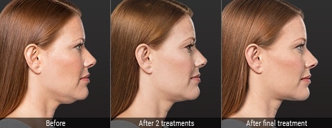 kybella-neck-treatment-before-after-results kybella neck treatment in naples and fort myers before and after results on a woman