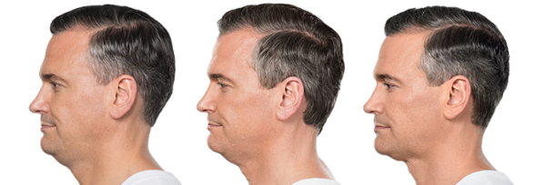 kybella-neck-treatment-fort-myers-naples-andy the before and after results of kybella neck treatment in fort myers and naples on a man