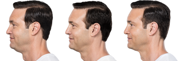 kybella-neck-treatment-fort-myers-naples-david the before and after results of kybella neck treatment in fort myers and naples on a man