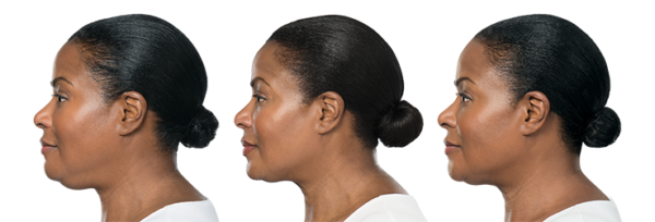 kybella-neck-treatment-fort-myers-naples-ponti the before and after results of kybella neck treatment in fort myers and naples on a woman