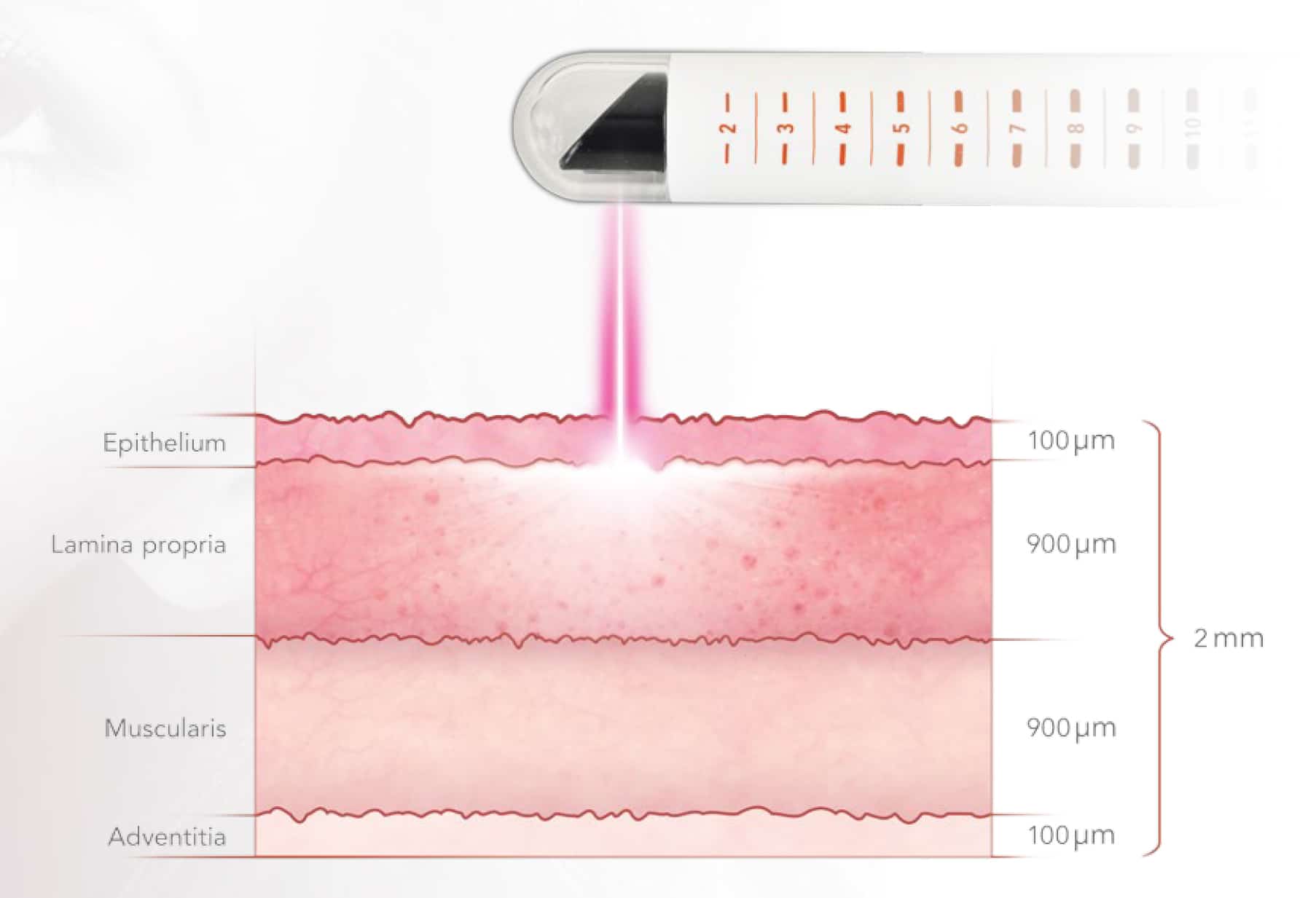 Julient and V-Lase Laser Vaginal Rejuvenation Mucosa Diagram