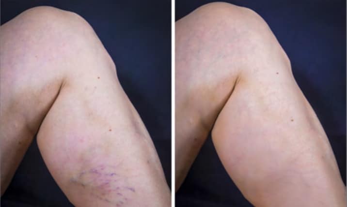sclerotherapy-spider-vein-treatment-before-after sclerotherapy spider vein treatment before and after results in fort myers and naples, fl