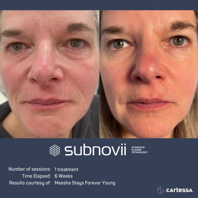 subnovii plasma skin treatment in cape coral and estero, fl before and after results