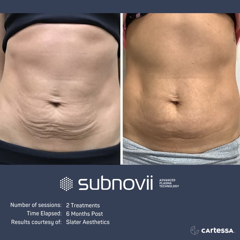 subnovii plasma skin treatment before and after results in fort myers and naples, fl