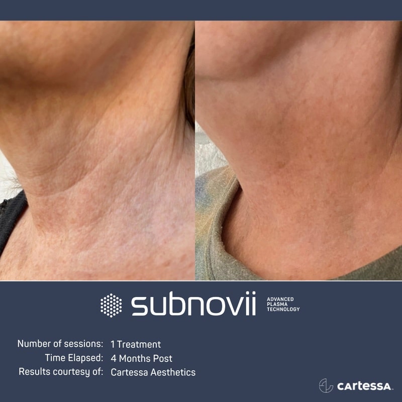 subnovii plasma skin treatment in bonita springs and cape coral, fl before and after results