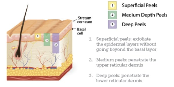 tca peel process explained