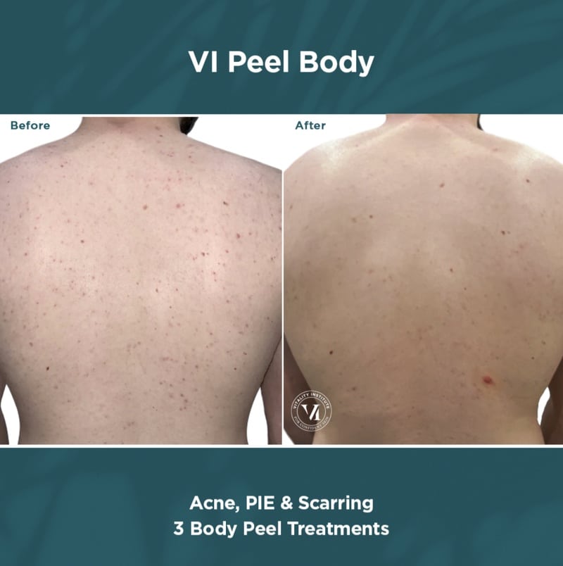 v1 peel body chemical peel before and after results on the back of a body